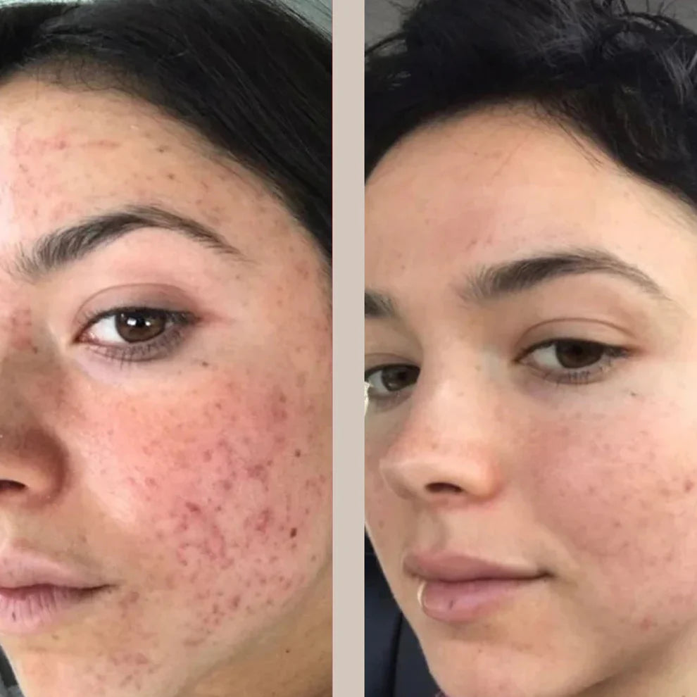 Hochwertige LED Maske von Lyvra für Anti-Akne und Anti-Aging Anwendung