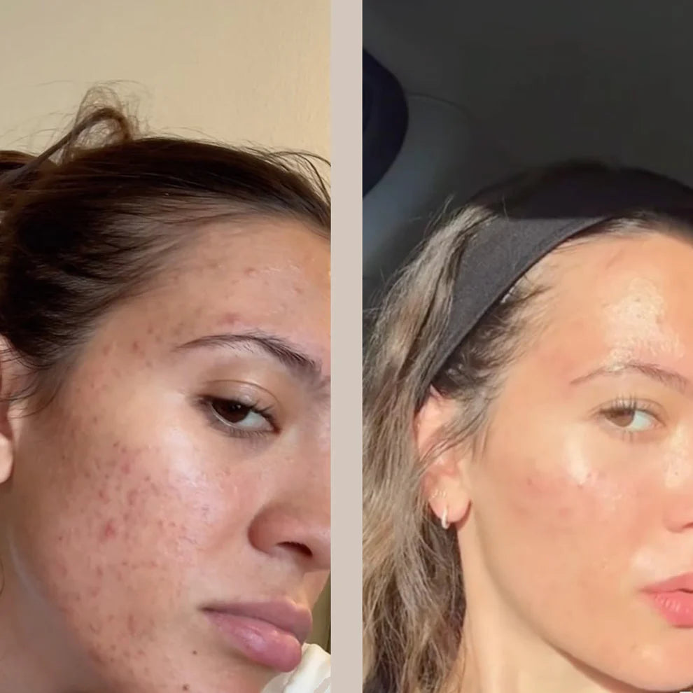 Lyvra 7-in-1 LED Lichttherapie Maske zur Hautstraffung, Aknebehandlung und Anti-Aging