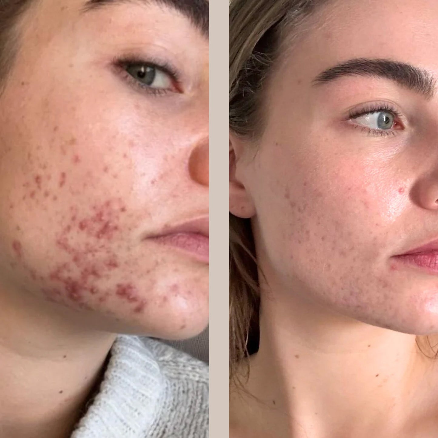 LED Lichttherapie Maske für Zuhause zur Kollagenanregung und Aknebehandlung